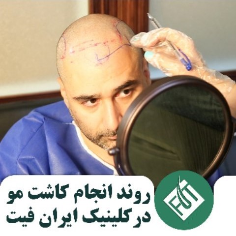 روند انجام کاشت مو در کلینیک ایران فیت