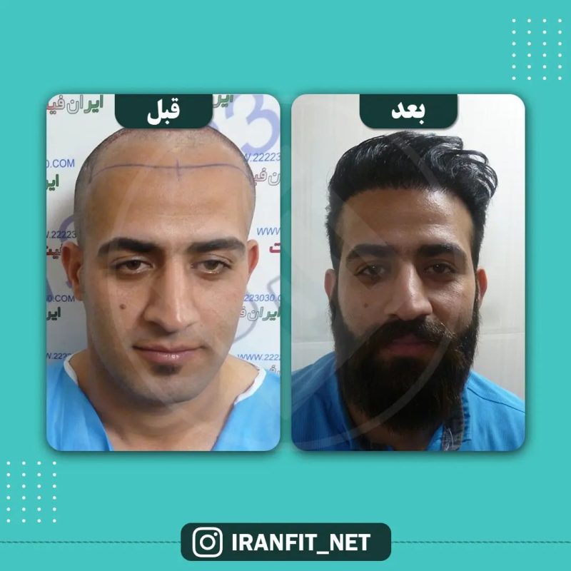 عکس قبل و بعد از کاشت مو به روش اف آی تی