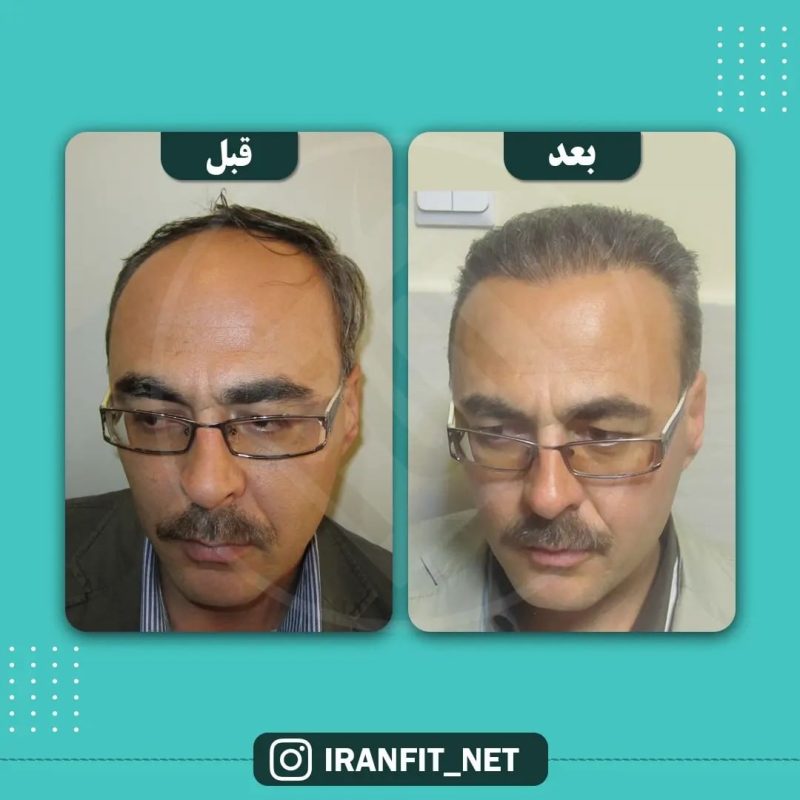 عکس قبل و بعد کاشت مو در کلینیک ایران فیت