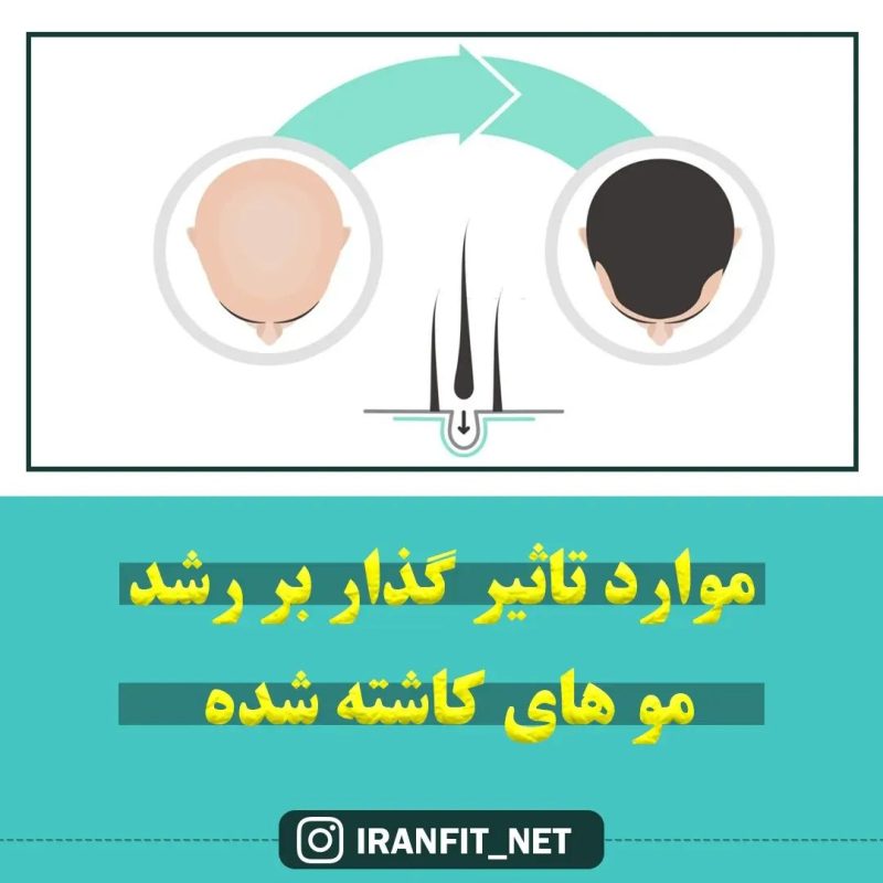 موارد تاثیرگذار بر رشد موهای کاشته شده