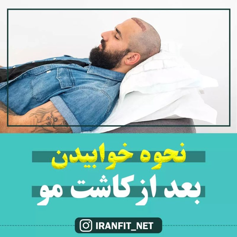 نحوه خوابیدن بعد از کاشت مو