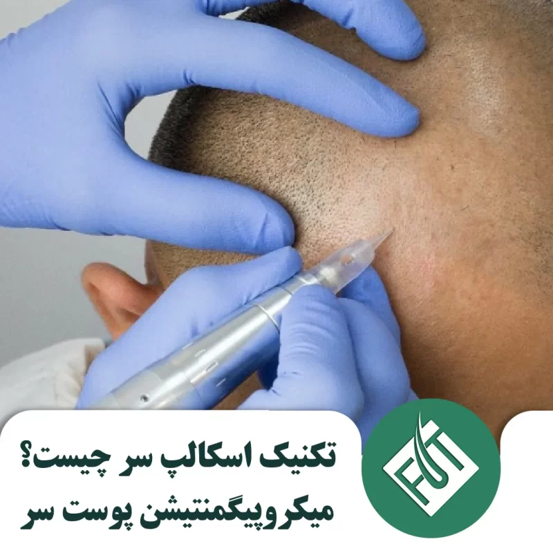 اسکالپ سر چیست؟ میکروپیگمنتیشن پوست سر اسکالپ سر چیست؟ میکروپیگمنتیشن پوست سر
