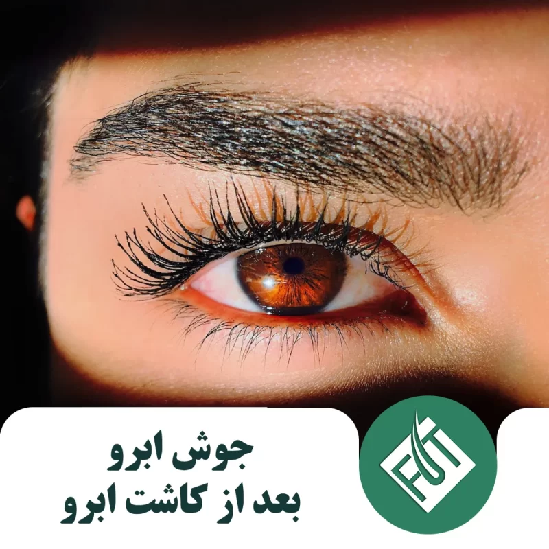 جوش ابرو بعد از کاشت ابرو جوش ابرو بعد از کاشت ابرو