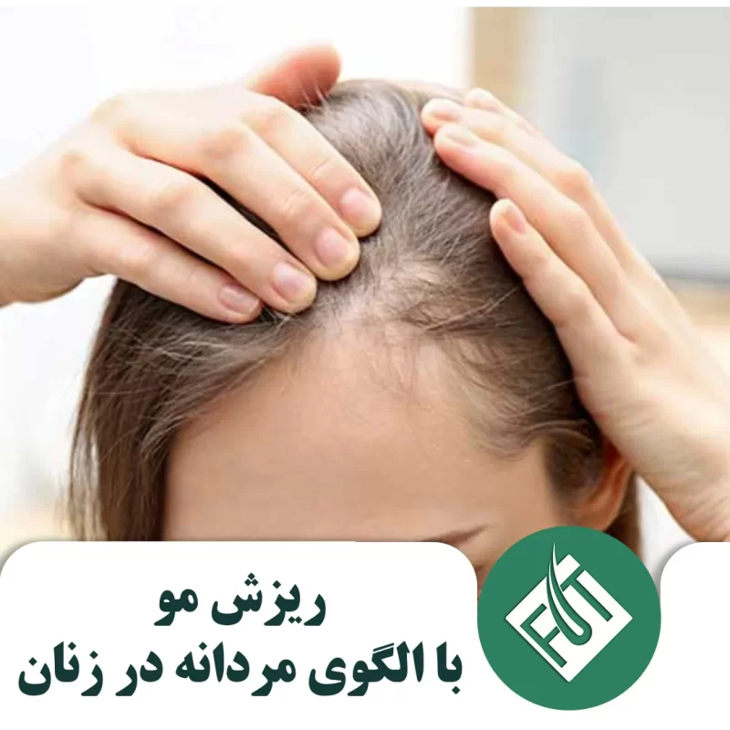 ریزش مو با الگوی مردانه در زنان