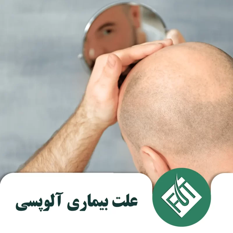 علت بیماری آلوپسی علت بیماری آلوپسی