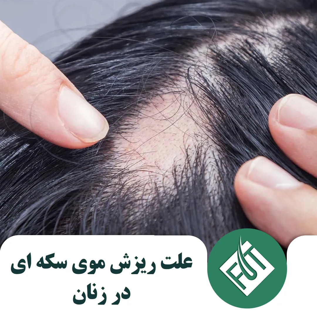 علت ریزش موی سکه ای در زنان