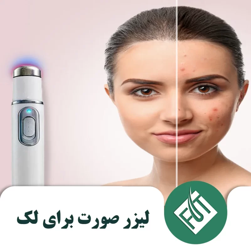 لیزر صورت برای لک
