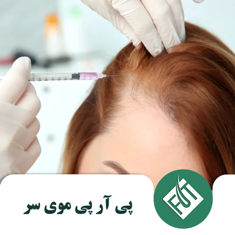 پی آر پی موی سر