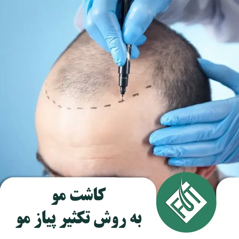 کاشت مو به روش تکثیر پیاز مو