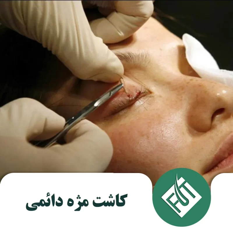 کاشت مژه دائمی