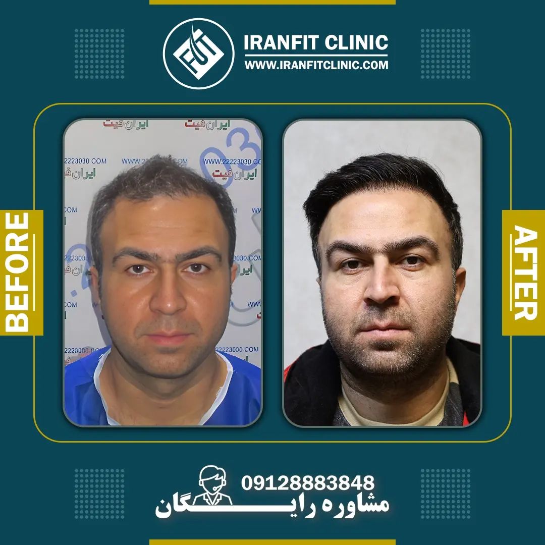 تصاویر قبل و بعد از کاشت مو در کلینیک ایران فیت