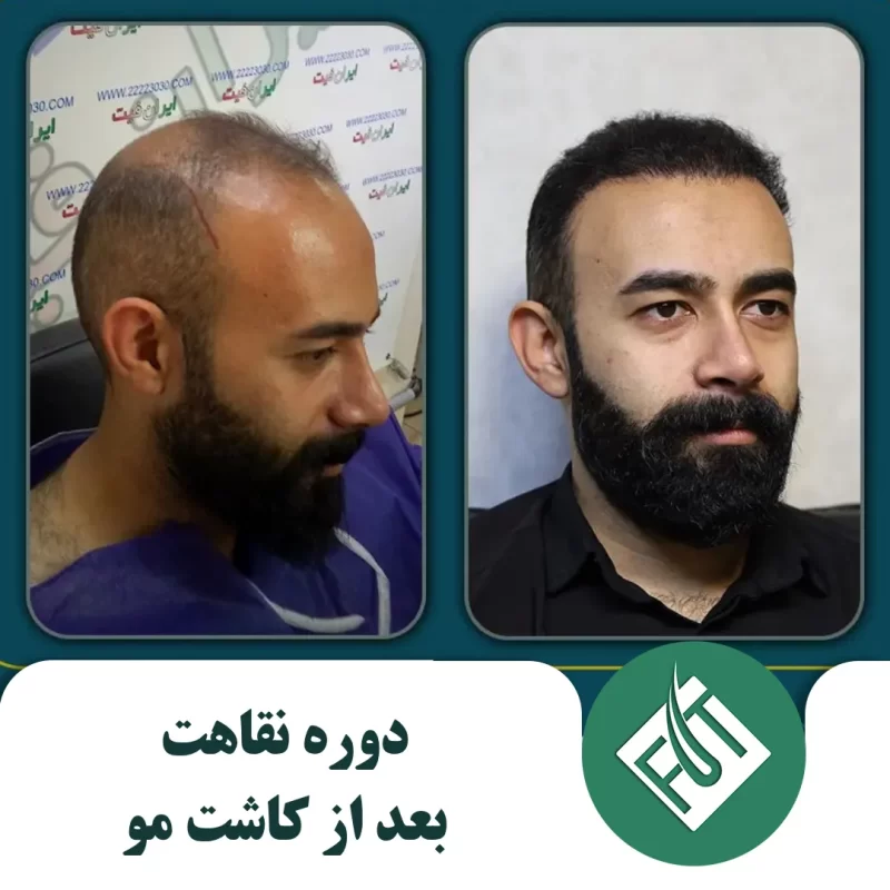 دوره نقاهت بعد از کاشت مو