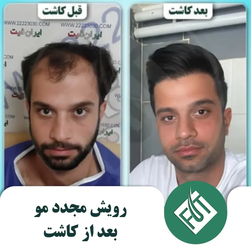 رویش مجدد مو بعد از کاشت